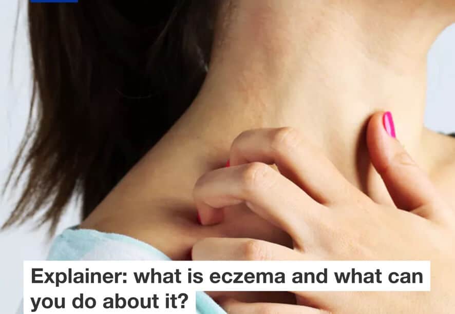 eczema