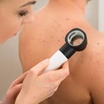 female doctor examining pigmented skin with dermatoscope