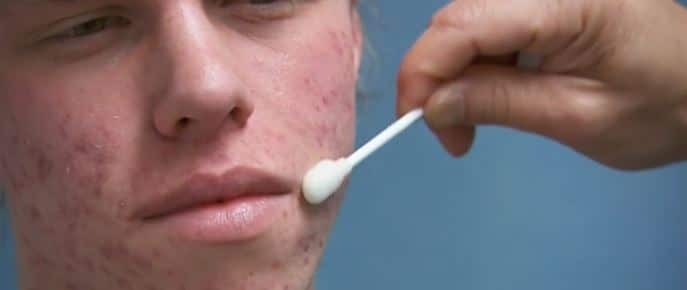 acne treatment application