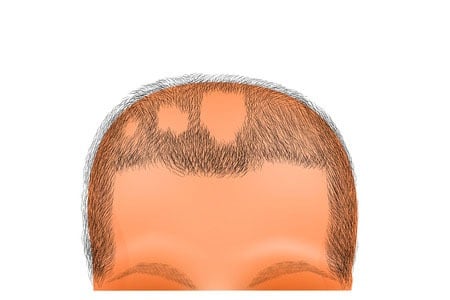 illustration of a head of person suffering from alopecia areata