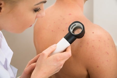 female doctor examining pigmented skin with dermatoscope