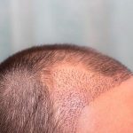 Hair Transplant